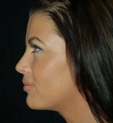 Rhinoplasty case #13086