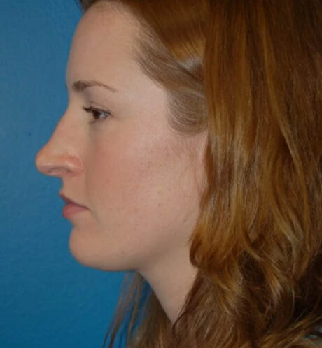 Rhinoplasty case #13110