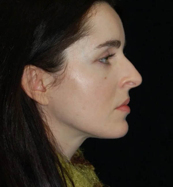 Rhinoplasty case #13120