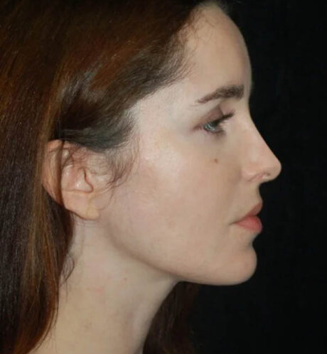 Rhinoplasty case #13120