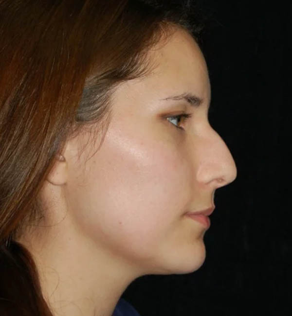 Rhinoplasty case #13128