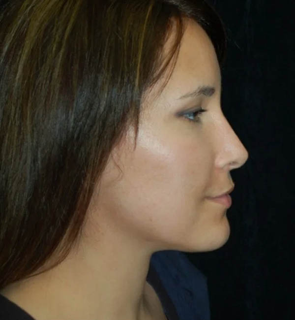 Rhinoplasty case #13128