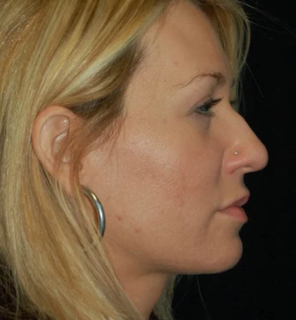 Rhinoplasty case #13129