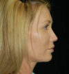 Rhinoplasty case #13129