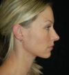 Rhinoplasty case #13159