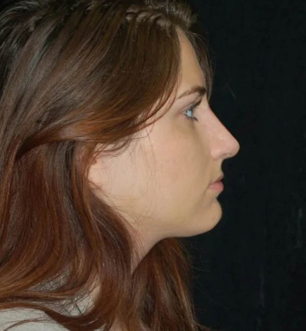 Rhinoplasty case #13175