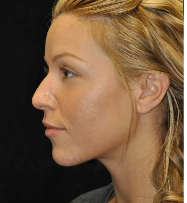 Rhinoplasty case #13206