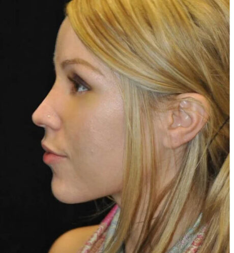 Rhinoplasty case #13206