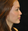 Rhinoplasty case #13228