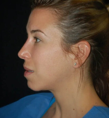 Rhinoplasty case #13235