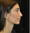 Rhinoplasty case #13238