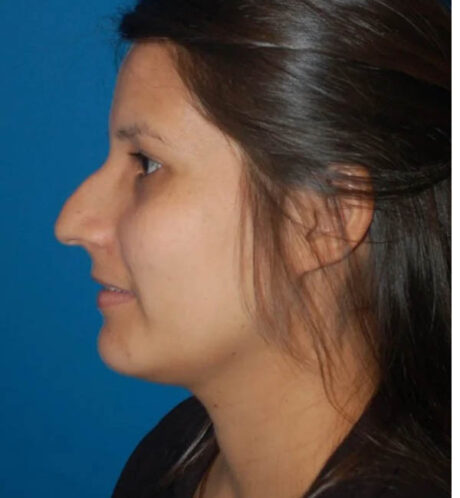 Rhinoplasty case #13243