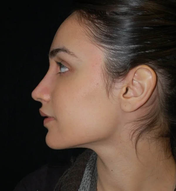 Rhinoplasty case #13264