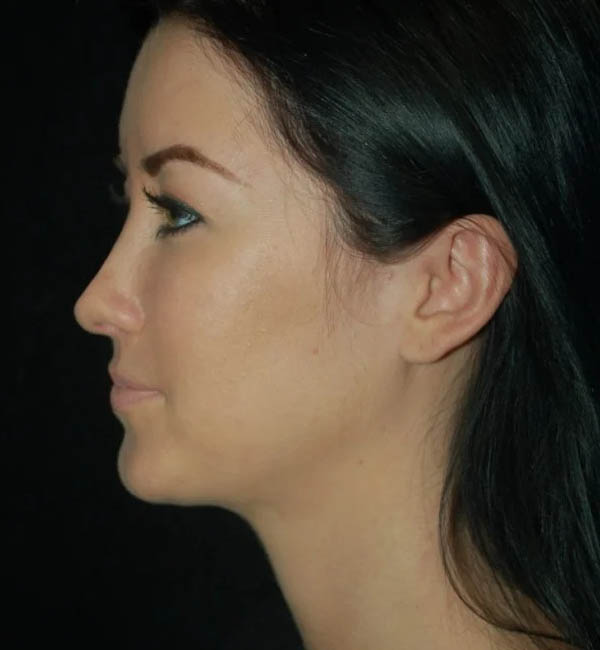 Rhinoplasty case #13267