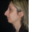 Rhinoplasty case #13289