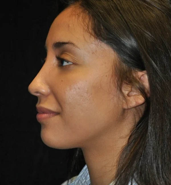 Rhinoplasty case #13292