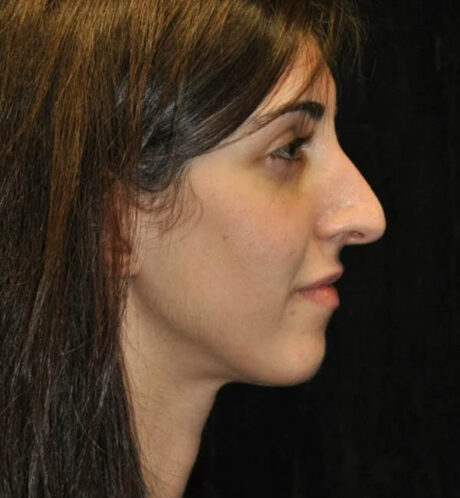 Rhinoplasty case #13295