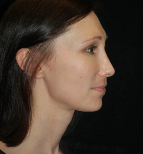 Rhinoplasty case #13300