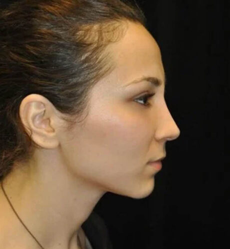 Rhinoplasty case #13345