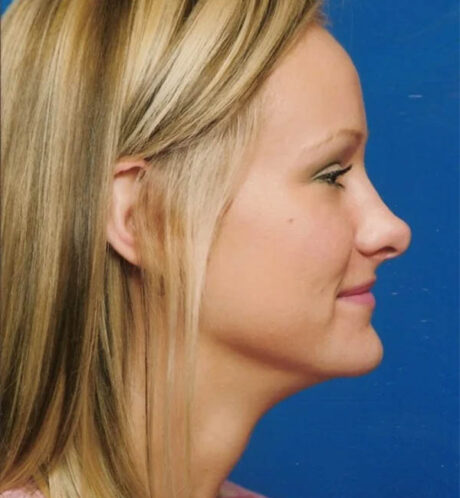 Rhinoplasty case #13103