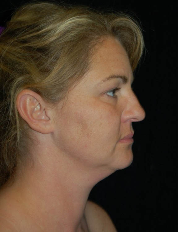 Facial Fat Grafting case #13804