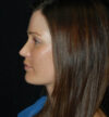 Rhinoplasty case #13824