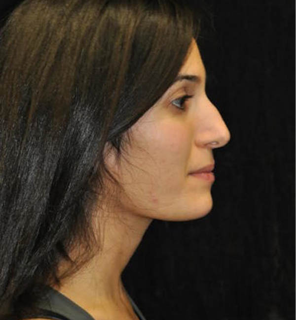 Rhinoplasty case #13830