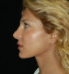 Revision Rhinoplasty case #13842