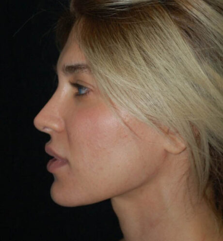 Revision Rhinoplasty case #13842