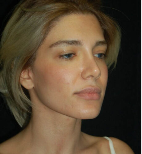 Revision Rhinoplasty case #13842