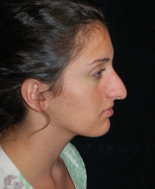 Before thumbnail for Case 18 Rhinoplasty Before and After Photos